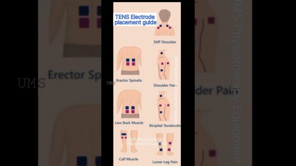 Électrodes TENS : Guide essentiel pour un soulagement efficace et sûr